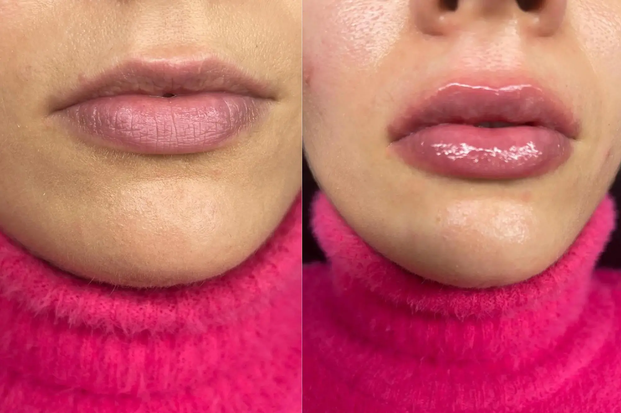 Resultado de antes y después de tratamiento de micropigmentación de labios en Ari Martínez Beauty